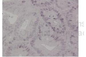 Sample Type: Human Colon Cancer Tissue Primary Dilution: 1ug/mL (MSH6 anticorps  (N-Term))