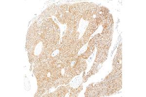 Immunohistochemistry (IHC) image for anti-Metadherin (MTDH) (AA 475-525) antibody (ABIN7795651)