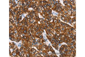 Immunohistochemistry of Human breast cancer using KRT8 Polyclonal Antibody at dilution of 1:40 (KRT8 anticorps)