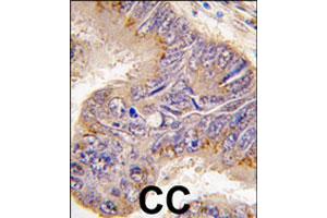 Formalin-fixed and paraffin-embedded human colon carcinoma tissue reacted with RPS6 polyclonal antibody  , which was peroxidase-conjugated to the secondary antibody, followed by DAB staining. (RPS6 anticorps  (N-Term))