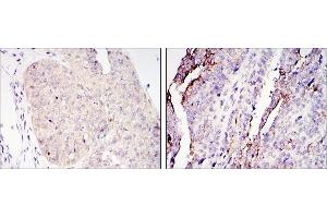 Immunohistochemical analysis of paraffin-embedded ovary tumour tissues (left) and lung cancer (right) using CRTC2 antibody with DAB staining. (CRTC2 anticorps)