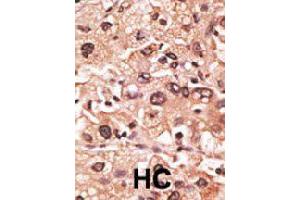 Formalin-fixed and paraffin-embedded human hepatocellular carcinoma tissue reacted with MAGEF1 polyclonal antibody  , which was peroxidase-conjugated to the secondary antibody, followed by AEC staining. (MAGEF1 anticorps  (C-Term))