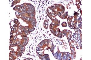 Immunohistochemical analysis of paraffin-embedded Colorectal cancer using BiP/GRP78 (C-terminus) Mouse mAb (1/100 dilution).