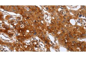 Immunohistochemistry of paraffin-embedded Human lung cancer using PLAUR Polyclonal Antibody at dilution of 1:60 (PLAUR anticorps)