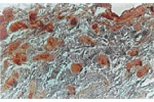 Immunhistochemical analysis in adipocytes of human breast carcinoma tissue using MKI67IP polyclonal antibody  at 1 : 500 dilution. (NIFK anticorps  (AA 144-160))