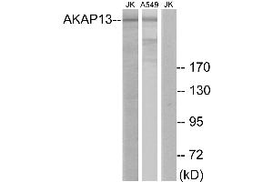 Immunohistochemistry analysis of paraffin-embedded human lung carcinoma tissue using AKAP13 antibody. (AKAP13 anticorps)