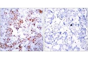 Immunohistochemistry analysis of paraffin-embedded human breast carcinoma tissue, using ATF2 (Ab-69 or 51) Antibody. (ATF2 anticorps  (AA 35-84))