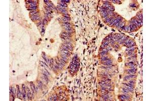 Immunohistochemistry of paraffin-embedded human colon cancer using ABIN7160959 at dilution of 1:100 (NDUFS4 anticorps  (AA 43-161))