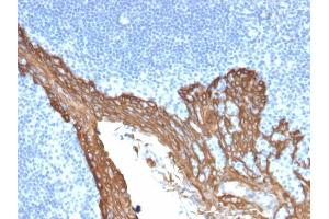 Formalin-fixed, paraffin-embedded human Prostate stained with Cytokeratin 8 Mouse Monoclonal Antibody (KRT8/2115). (KRT8 anticorps)