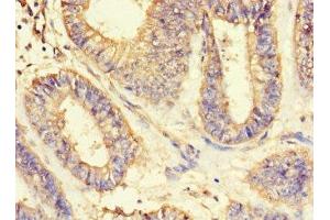 Immunohistochemistry of paraffin-embedded human endometrial cancer using ABIN7143597 at dilution of 1:100 (ASIP anticorps  (AA 23-112))