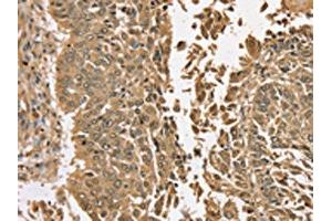 The image on the left is immunohistochemistry of paraffin-embedded Human lung cancer tissue using (TGM6 Antibody) at dilution 1/35, on the right is treated with synthetic peptide. (TGM6 anticorps)