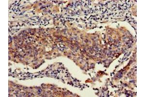 Immunohistochemistry of paraffin-embedded human cervical cancer using ABIN7151111 at dilution of 1:100