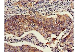 Immunohistochemistry of paraffin-embedded human cervical cancer using ABIN7151111 at dilution of 1:100 (RBBP6 anticorps  (AA 51-97))