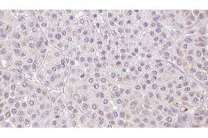 ABIN6276750 at 1/100 staining Human melanoma tissue by IHC-P. (PROS1 anticorps  (N-Term))