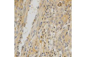 Immunohistochemistry of paraffin-embedded human stomach cancer using TNFRSF11B antibody at dilution of 1:200 (x400 lens) (Osteoprotegerin anticorps)