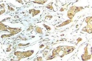 Immunohistochemistry (IHC) analyzes of STAT1 antibody in paraffin-embedded human breast carcinoma tissue. (STAT1 anticorps)