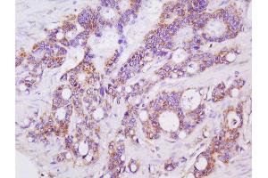 Formalin-fixed and paraffin embedded human colon carcinoma labeled with Anti-LGALS3BP Polyclonal Antibody, Unconjugated  at 1:200 followed by conjugation to the secondary antibody and DAB staining