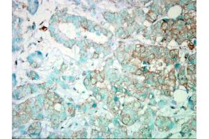 IHC-P Image Immunohistochemical analysis of paraffin-embedded Human Breast Cancer, using PI3 kinase p110 alpha, antibody.