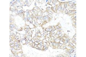 Immunohistochemistry of paraffin-embedded Human lung cancer using ATP1B1 Polyclonal Antibody at dilution of 1:100 (40x lens).
