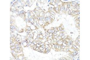 Immunohistochemistry of paraffin-embedded Human lung cancer using ATP1B1 Polyclonal Antibody at dilution of 1:100 (40x lens). (ATP1B1 anticorps)