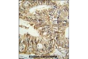 G Antibody (C-term) (ABIN652835 and ABIN2842544) IHC analysis in formalin fixed and paraffin embedded human colon carcinoma followed by peroxidase conjugation of the secondary antibody and DAB staining. (GPA33 anticorps  (C-Term))