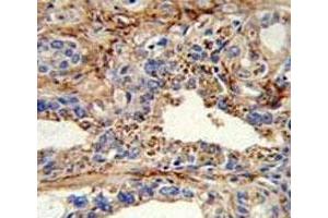 IHC analysis of FFPE human prostate carcinoma with CDK4 antibody
