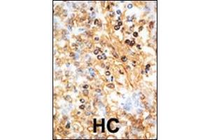 Formalin-fixed and paraffin-embedded human cancer tissue reacted with the primary antibody, which was peroxidase-conjugated to the secondary antibody, followed by AEC staining.
