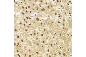 Immunohistochemistry of paraffin-embedded human liver injury using ANP32A Antibody.
