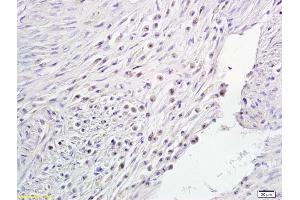 Formalin-fixed and paraffin embedded human endometrial cancer labeled with Anti-Notch1/MOTC Polyclonal Antibody, Unconjugated (ABIN675114) followed by conjugation to the secondary antibody and DAB staining (Notch1 anticorps  (AA 2101-2300))