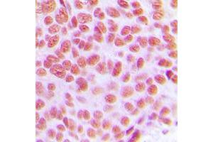 Immunohistochemical analysis of AP2 gamma staining in human breast cancer formalin fixed paraffin embedded tissue section.