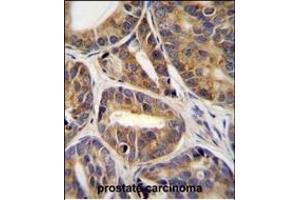 RN Antibody (C-term) (ABIN655838 and ABIN2845252) immunohistochemistry analysis in formalin fixed and paraffin embedded human prostate carcinoma tissue followed by peroxidase conjugation of the secondary antibody and DAB staining.