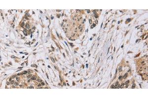 Immunohistochemistry of paraffin-embedded Human esophagus cancer tissue using PDLIM7 Polyclonal Antibody at dilution 1:35 (PDLIM7 anticorps)