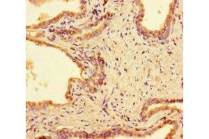 Immunohistochemistry of paraffin-embedded human prostate cancer using ABIN7165948 at dilution of 1:100 (PPM1H anticorps  (AA 73-289))