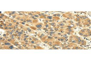 Immunohistochemistry of paraffin-embedded Human liver cancer tissue using UACA Polyclonal Antibody at dilution 1:45 (UACA anticorps)