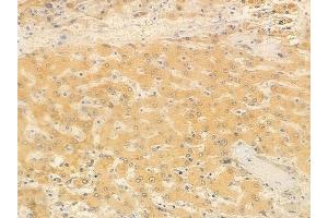 ABIN6260215 and ABIN6266858 at 1/100 staining human hepatocellular carcinoma by IHC-P.