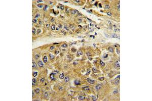 Formalin-fixed and paraffin-embedded human hepatocarcinoma reacted with SERPINA7 Antibody , which was peroxidase-conjugated to the secondary antibody, followed by DAB staining. (SERPINA7 anticorps  (C-Term))