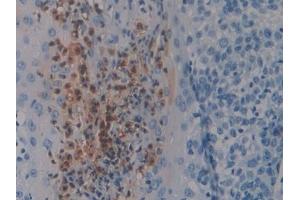 Detection of S100P in Human Skin cancer Tissue using Polyclonal Antibody to S100 Calcium Binding Protein P (S100P)