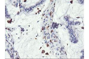 Immunohistochemical staining of paraffin-embedded Adenocarcinoma of Human colon tissue using anti-SDS mouse monoclonal antibody. (serine Dehydratase anticorps)