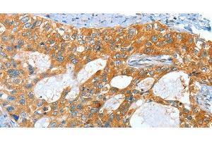 Immunohistochemistry of paraffin-embedded Human cervical cancer tissue using AMHR2 Polyclonal Antibody at dilution 1:40 (AMHR2 anticorps)