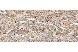 Immunohistochemistry of paraffin-embedded Human cervical cancer tissue using H3F3B Polyclonal Antibody at dilution of 1:40(x200)