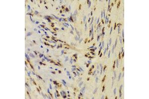 Immunohistochemistry of paraffin-embedded Human adenomyosis using XRCC5 antibody at dilution of 1:100 (40x lens). (XRCC5 anticorps)