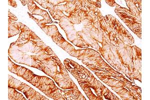 Formalin-fixed, paraffin-embedded human Colon Carcinoma stained with Cytokeratin 8 Mouse Monoclonal Antibody (H1).