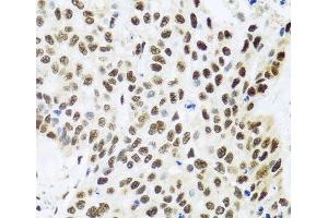 Immunohistochemistry of paraffin-embedded Human lung cancer using FUBP1 Polyclonal Antibody at dilution of 1:100 (40x lens). (FUBP1 anticorps)