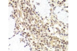 Immunohistochemistry of paraffin-embedded Human adenomyosis using PHC1 Polyclonal Antibody at dilution of 1:200 (40x lens). (PHC1 anticorps)