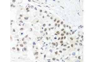 Immunohistochemistry of paraffin-embedded Human lung cancer using TRMT1 Polyclonal Antibody at dilution of 1:100 (40x lens). (TRMT1 anticorps)