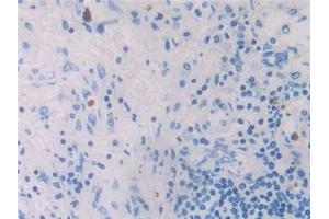 Detection of MIP4a in Human Lung cancer Tissue using Polyclonal Antibody to Macrophage Inflammatory Protein 4 Alpha (MIP4a) (CCL26 anticorps  (AA 24-94))