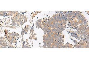Immunohistochemistry of paraffin-embedded Human lung cancer tissue using GPR153 Polyclonal Antibody at dilution of 1:40(x200) (GPR153 anticorps)