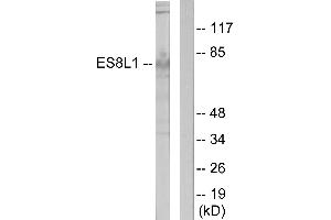 Immunohistochemistry analysis of paraffin-embedded human colon carcinoma tissue using ES8L1 antibody. (EPS8-Like 1 anticorps)