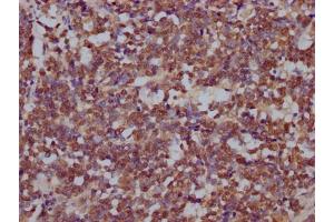 IHC image of ABIN7168099 diluted at 1:200 and staining in paraffin-embedded human lung cancer performed on a Leica BondTM system. (DROSHA anticorps  (AA 1-100))