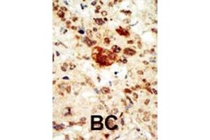 Formalin-fixed and paraffin-embedded human cancer tissue reacted with the primary antibody, which was peroxidase-conjugated to the secondary antibody, followed by AEC staining.